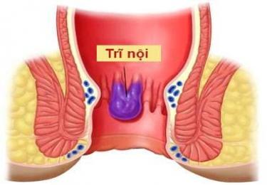 Giải đáp tất tần tật về bệnh trĩ nội: Nhận biết triệu chứng càng sớm - Hiệu quả điều trị càng cao