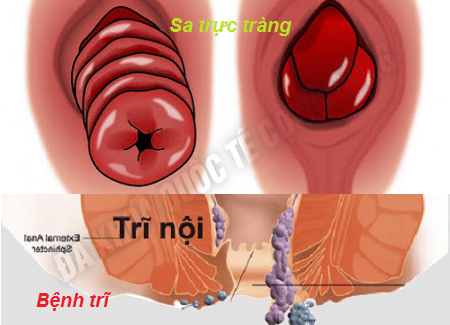 -benh-tri-va-benh-sa-truc-trang