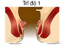 hình ảnh bênh trĩ nội