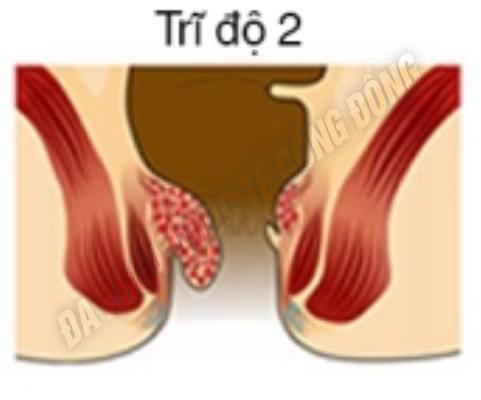 ảnh bệnh trĩ nội