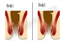 cách chữa trĩ ngoại nhẹ