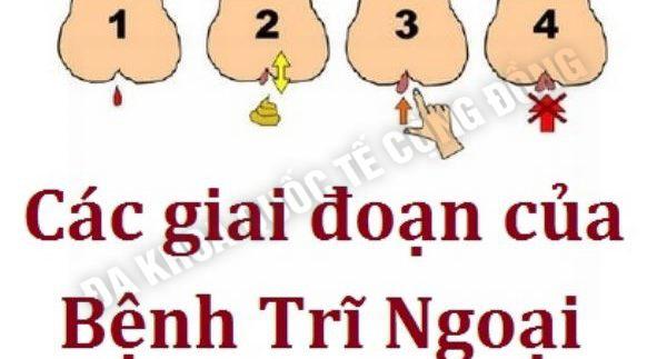 Giai đoạn của bệnh trĩ