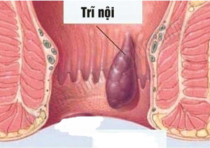 nhận biết trĩ nội trĩ ngoại