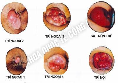 dấu hiệu bệnh trĩ ngoại