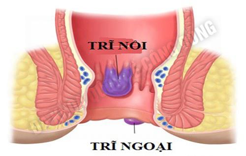 trĩ nội trĩ ngoại là gì