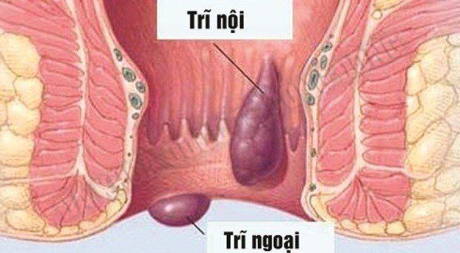 cách phân biệt bệnh trĩ nội trĩ ngoại