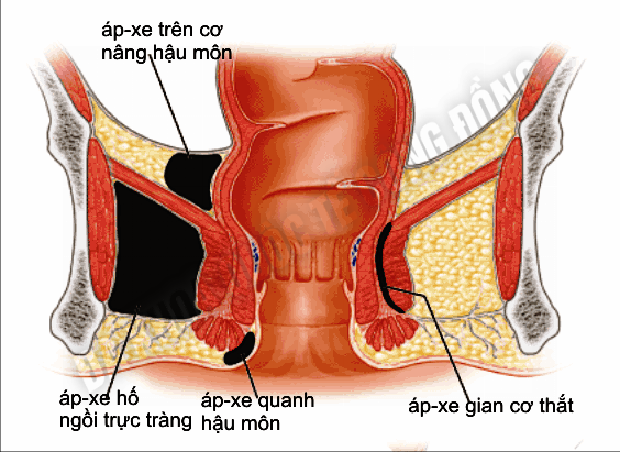 benh-ap-xe-hau-mon_1