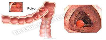 benh-polyp-hau-mon