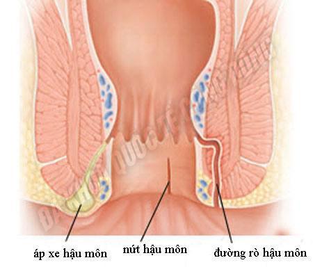 benh-ro-hau-mon-co-nguy-hiem-khong-1