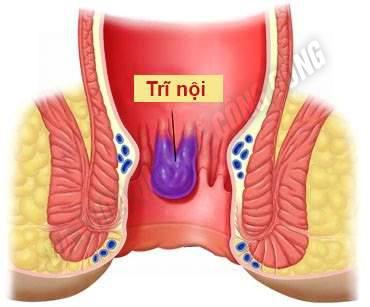 benh-tri-noi