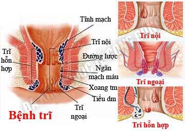 benh-tri_6