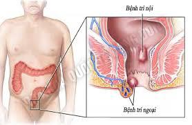 Cách trị bệnh trĩ ngoại