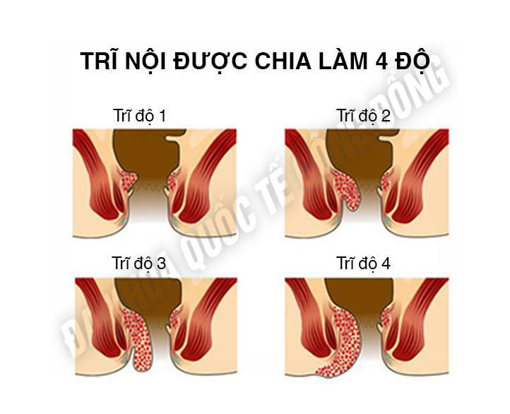 cấp độ bệnh trĩ nội