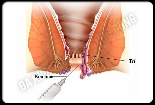 chữa bệnh trĩ nội