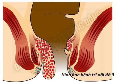 biểu hiện bệnh trĩ ngoại độ 3