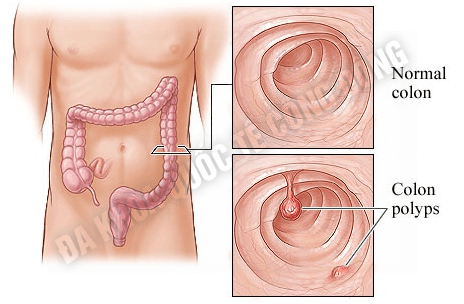 dieu-tri-polyp-hau-mon-nhu-the-nao