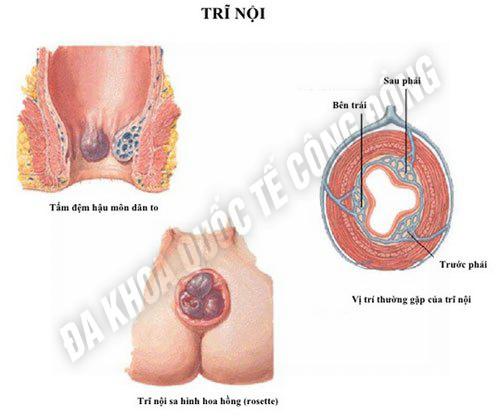 hiện tượng bệnh trĩ nội