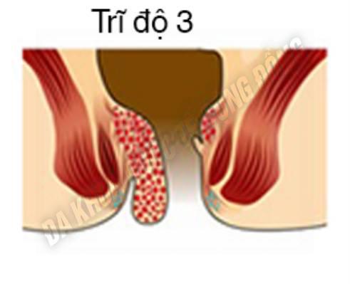 Trĩ độ 3 có cần phẫu thuật không?