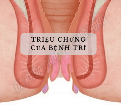 Triệu chứng của bệnh trĩ