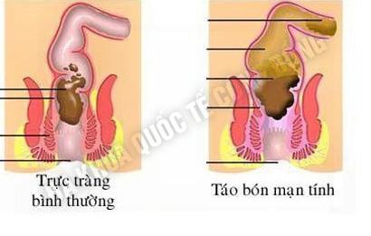 nhung-cach-chua-tao-bon-hieu-qua-benhduongtieuhoa2