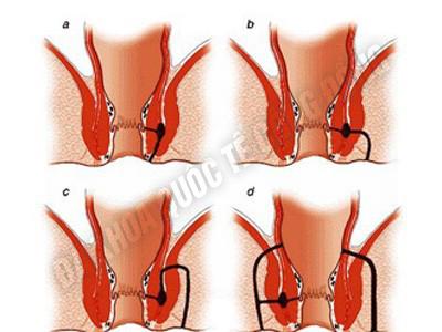 rò hậu môn