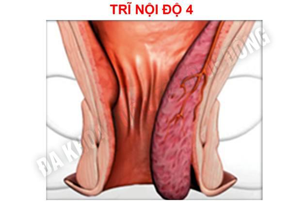 nguy hại từ trĩ nội độ 4