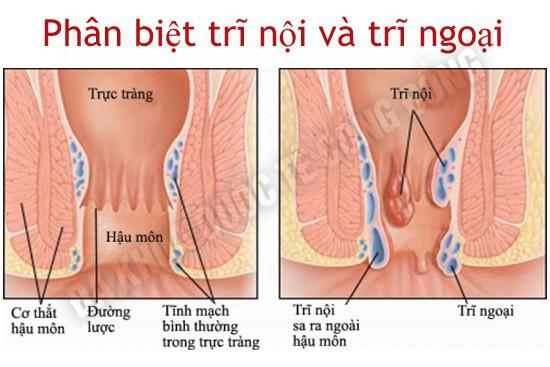 phân biệt trĩ nội trĩ ngoại