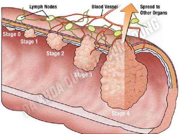 polyp-truc-trang