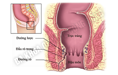 rò hậu môn