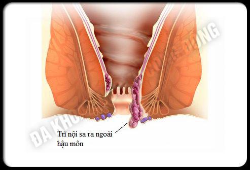 các triệu chứng của bệnh trĩ nội