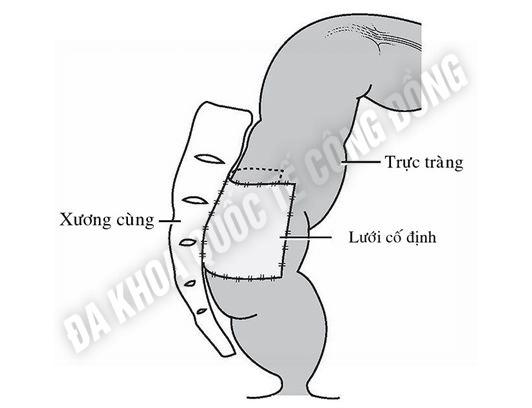 sa trực tràng