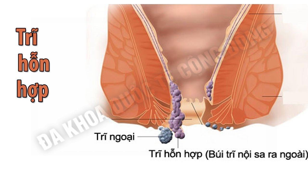 tri hon hop 0_1