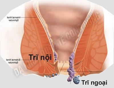 bệnh trĩ nội trĩ ngoại