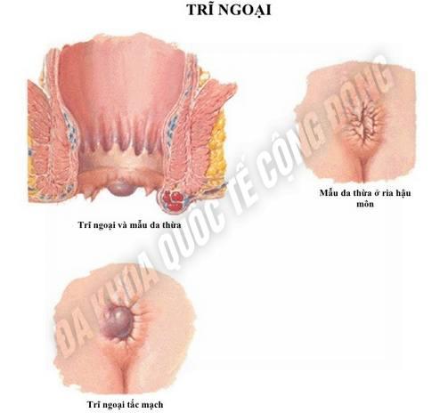 trĩ ngoại độ 1