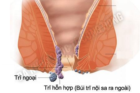 trieu-chung-va-cach-dieu-tri-tri-hon-hop-1 (1)